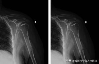 肩关节后脱位肩袖修补术,肩关节习惯性脱位修复手术评残