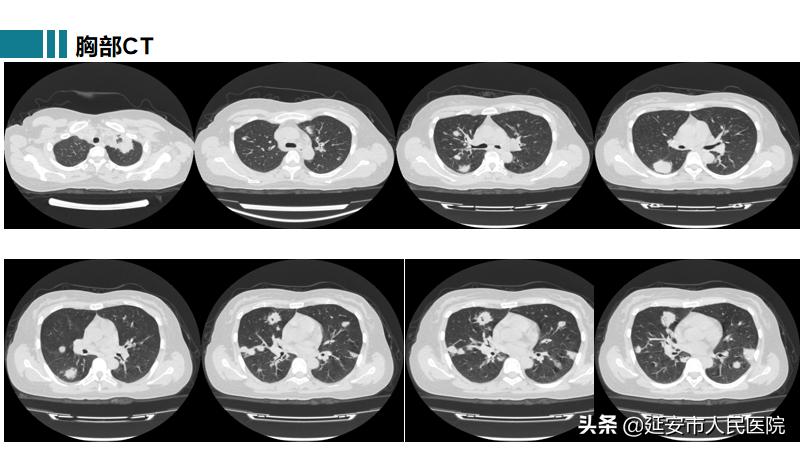 治疗肉芽肿性血管炎哪家医院好,嗜酸性肉芽肿性血管炎哪家医院好