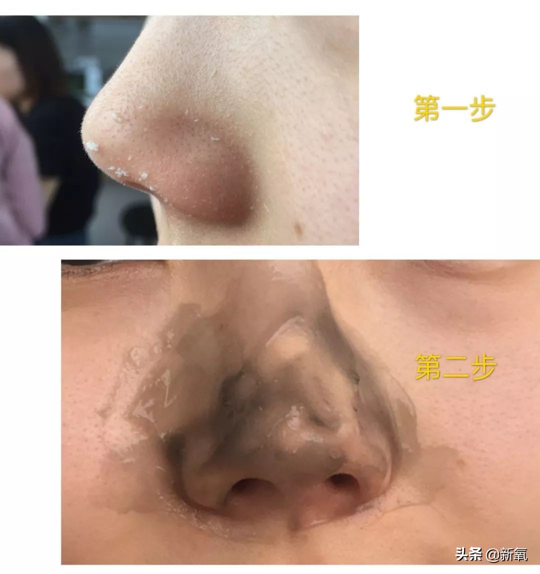 五分钟教你有效去黑头,最火去黑头收缩毛孔