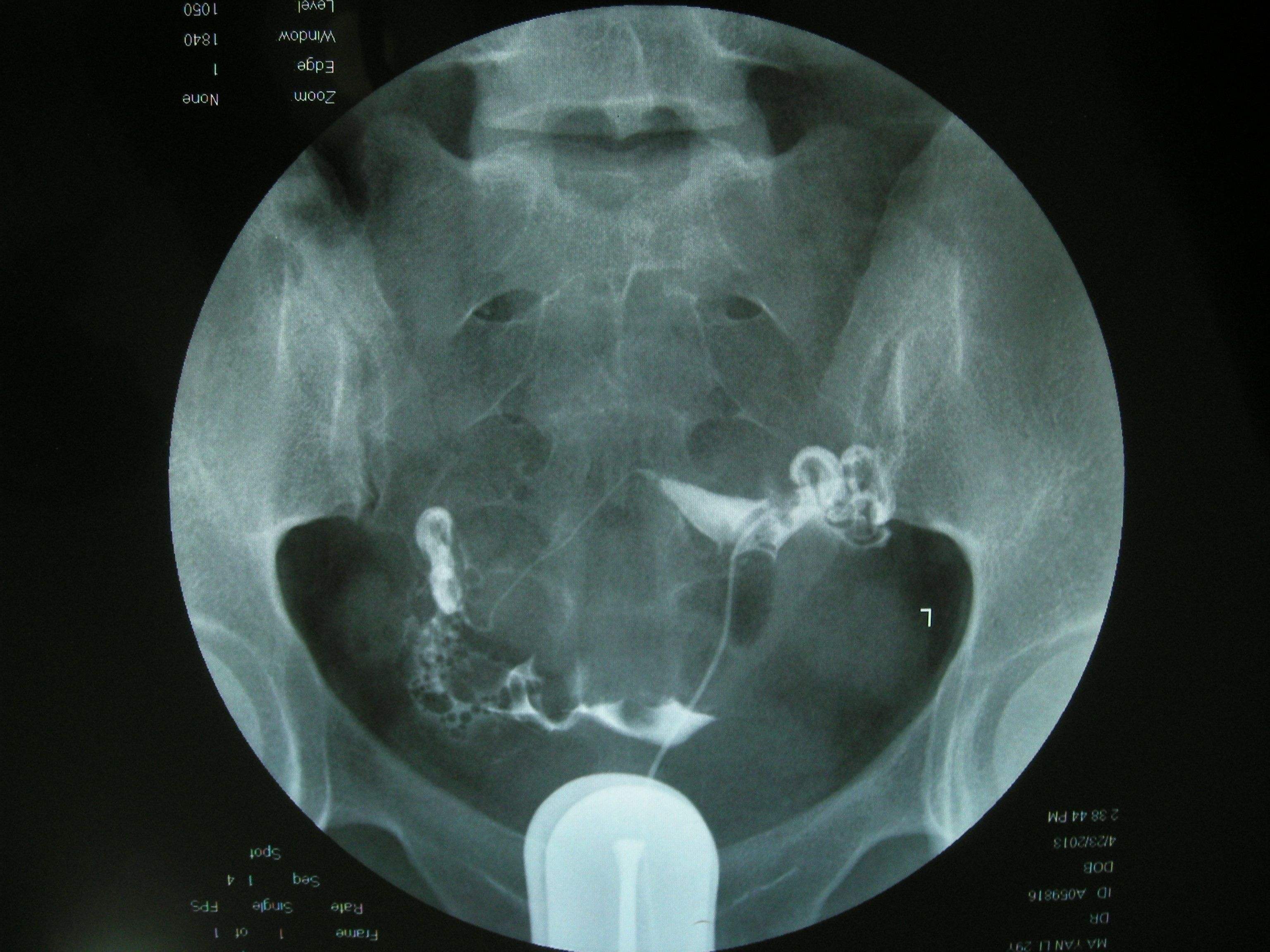 输卵管造影检查前能吃早餐吗,输卵管造影能检查卵巢功能吗