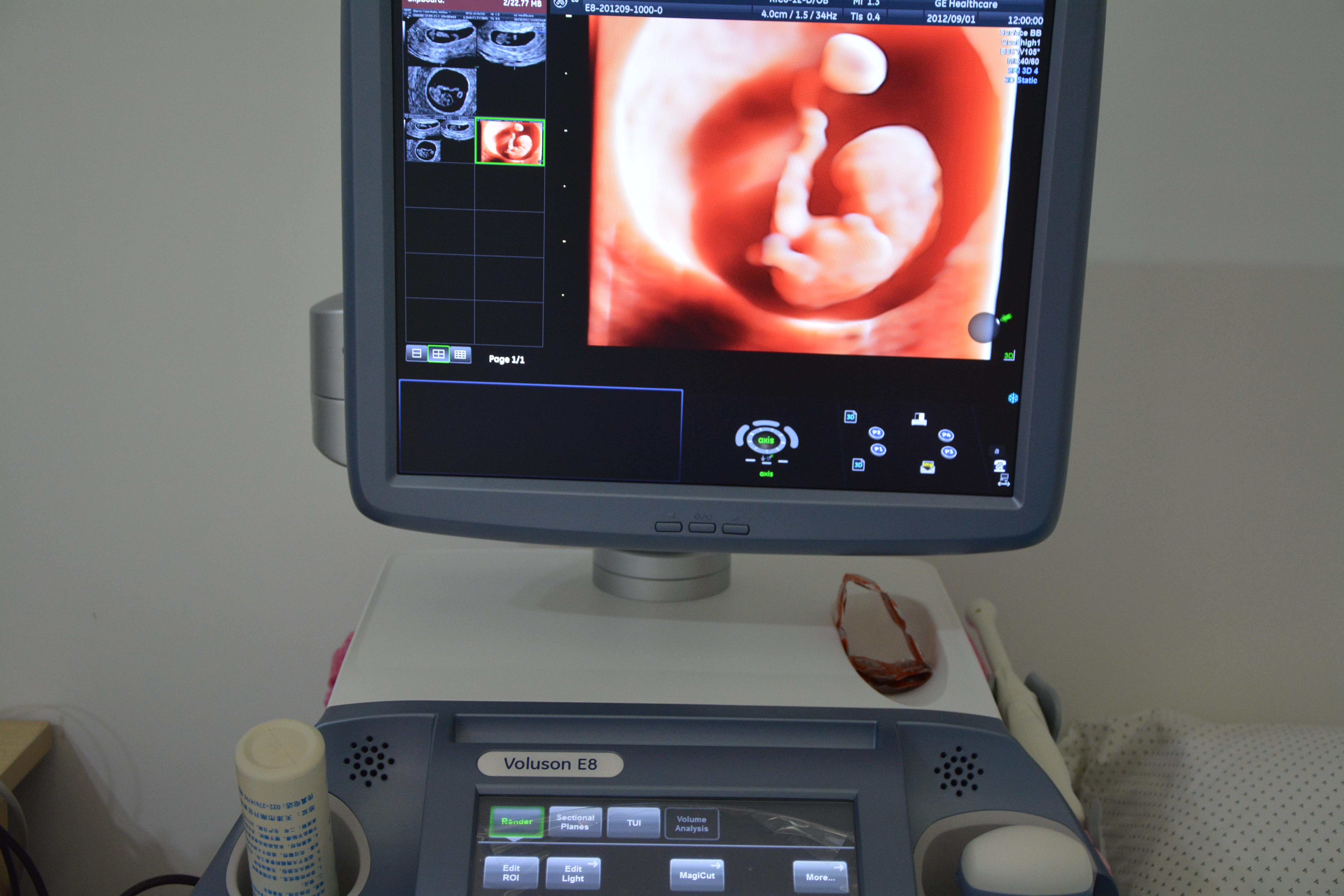 四维图片看着胎儿鼻子大怎么回事,胎儿四维彩超显示脑门大