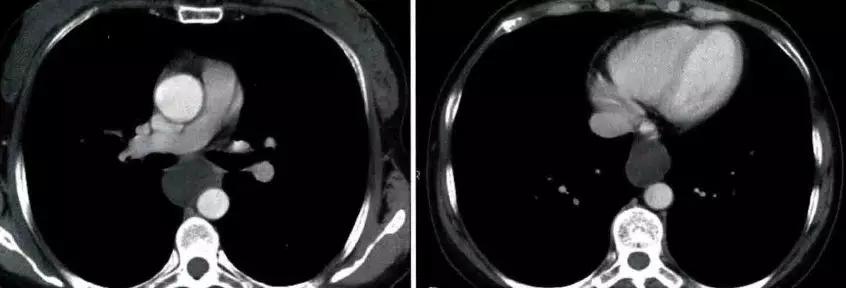 胸腺增生和纵隔肿瘤的区别和症状,纵隔胸腺肿瘤的常见临床症状表现