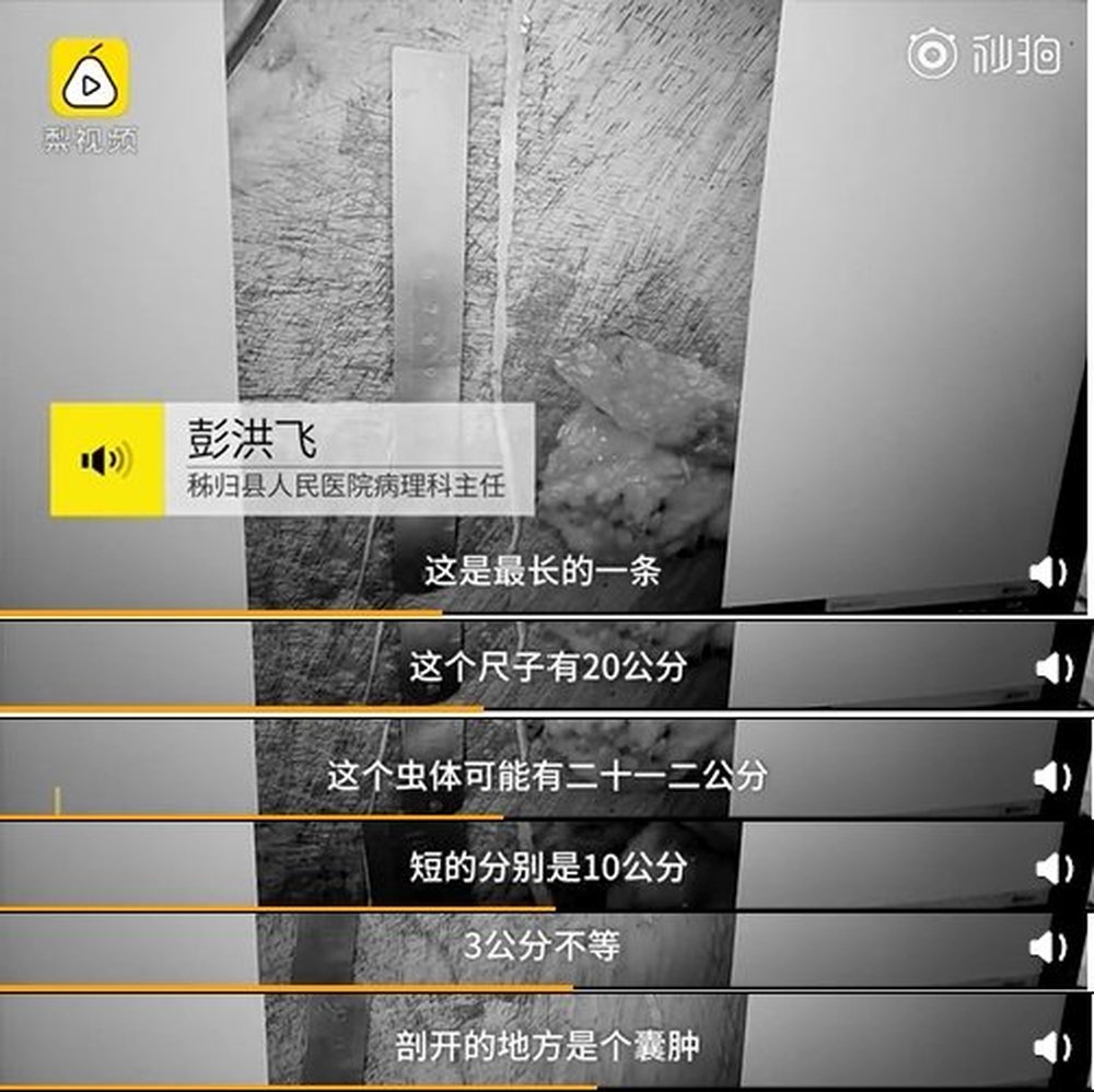 小孩眼睛里长阴虱,4岁小孩睫毛长满阴虱瘙痒难忍