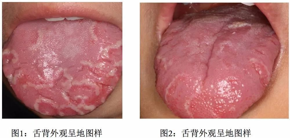宝宝有“地图舌”是怎么回事？脾胃虚弱如何调理？