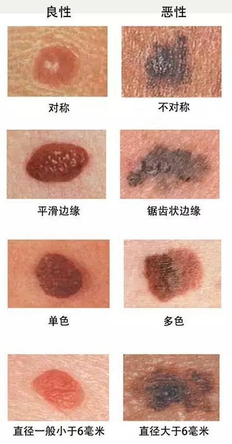 点痣点出恶性肿瘤,点痣点出黑色素瘤