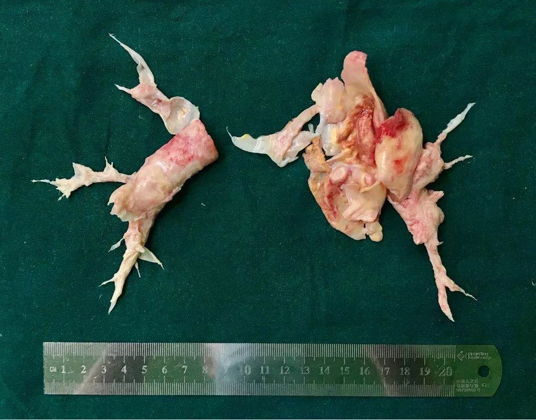 肺动脉血栓栓塞引起的肺高压,慢性血栓性肺动脉高压吃什么中药