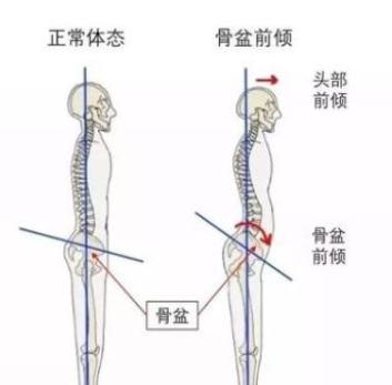治疗骨盆前倾引起腰痛的锻炼方法,骨盆前倾腰疼纠正最快的方法