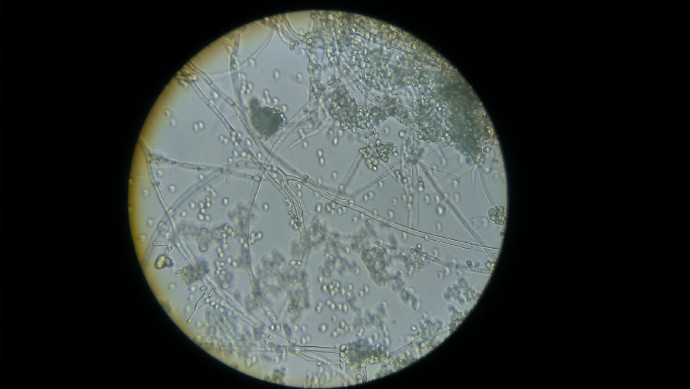 孕期外阴瘙痒会有什么影响吗,孕期白带一直绿色外阴瘙痒