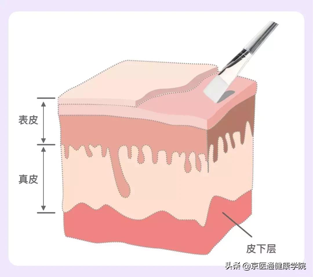 刷酸注意事项及使用方法,刷酸的弊端