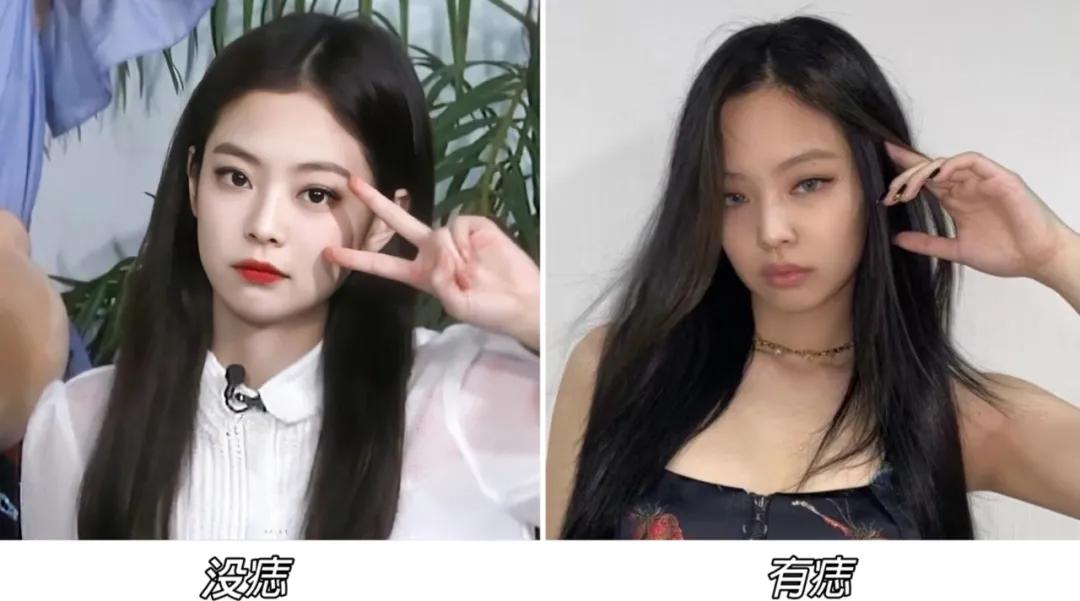 点痣就能变美,点痣整容大法