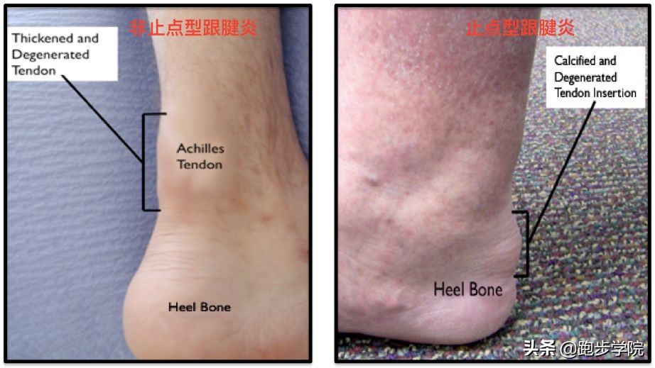 跑步怎样预防跟腱炎,预防跟腱炎最好的方法