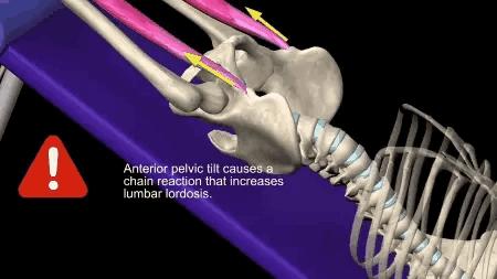 练习腹肌的神器，却是腰椎间盘突出的祸首