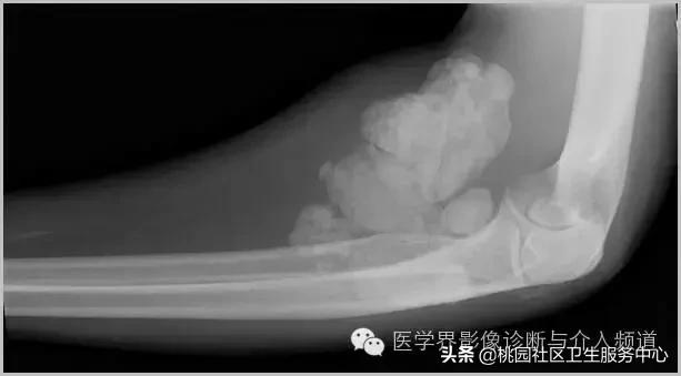 软组织钙化是不是骨化性肌炎,软组织钙化或骨化