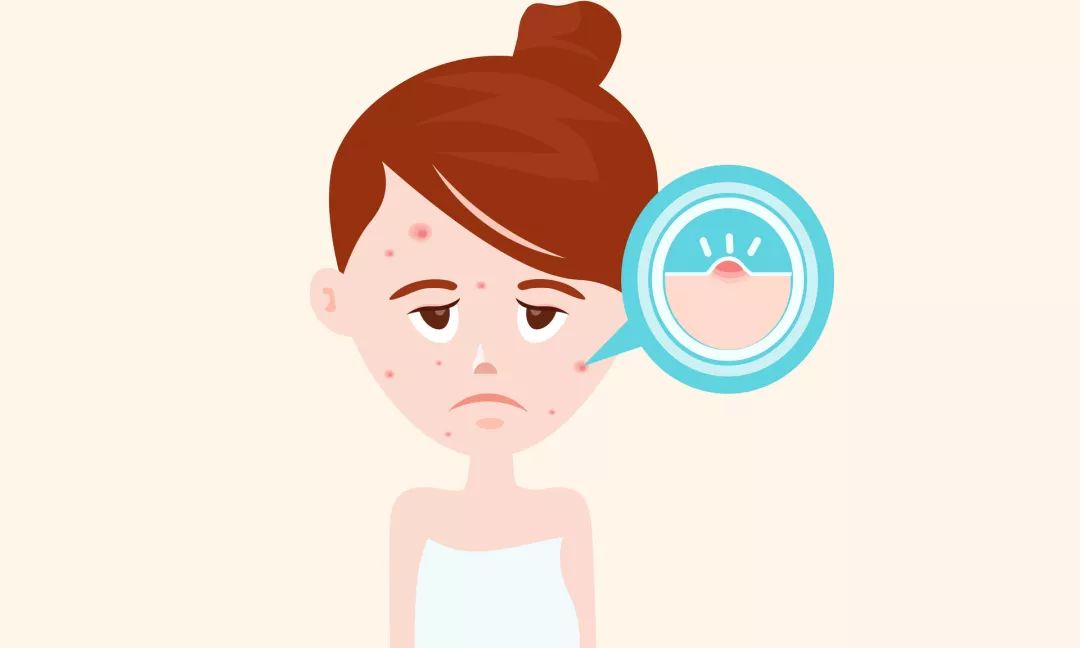 祛除粉刺闭口痘印的方法真实有效,祛除痘印闭口推荐什么产品