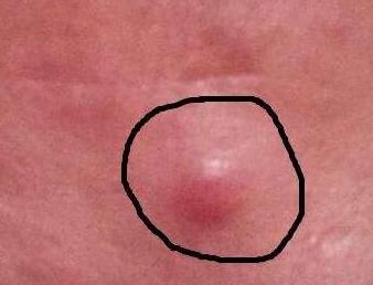 教你几招祛痘印的最快方法,怎么祛痘印最简单实用的方法