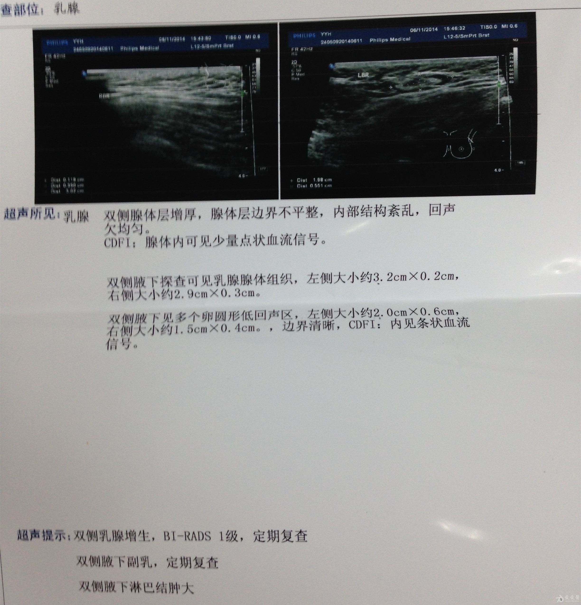 结节息肉囊肿增生哪个更容易癌变,结节囊肿增生息肉有什么区别