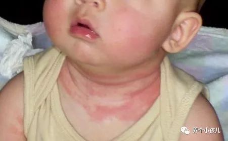 宝宝出现湿疹的原因和护理措施,高烧湿疹的症状及治疗方法