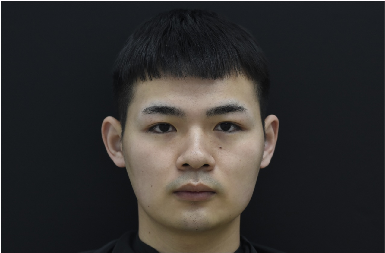 玻尿酸隆鼻鼻子变宽怎么办,玻尿酸隆鼻变宽了还能隆鼻吗