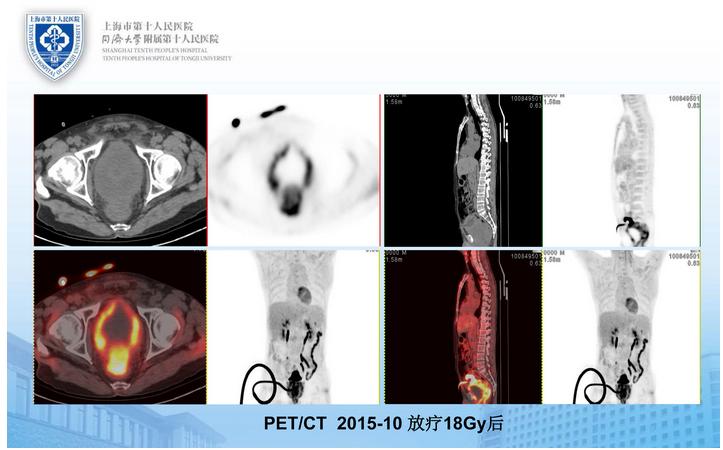 一例“超级复杂”T4期前列腺癌的手术治疗