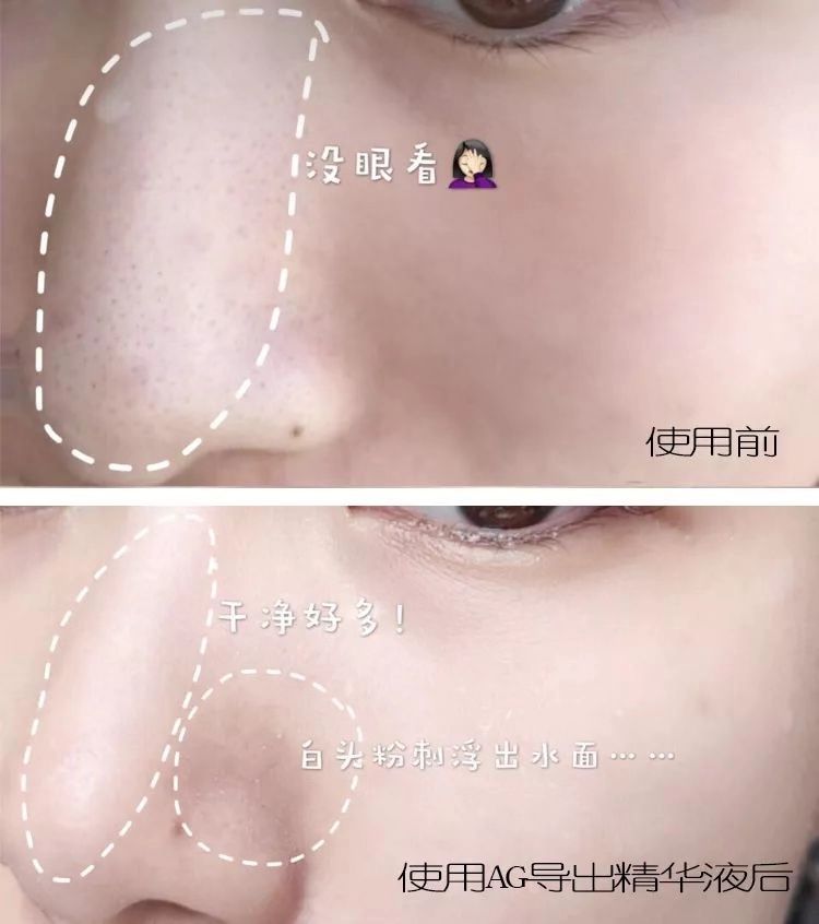 一秒去黑头去粉刺,一步就能搞定的黑头