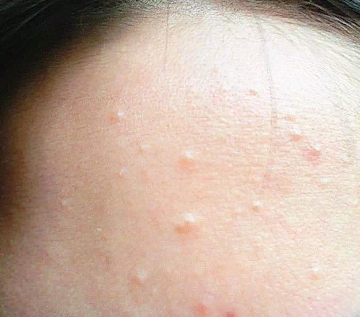 闭口应该怎么处理,闭口怎么办最有效的方法