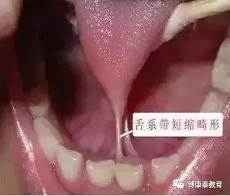 博康泰丨剪舌筋：该不该让孩子挨这一刀？