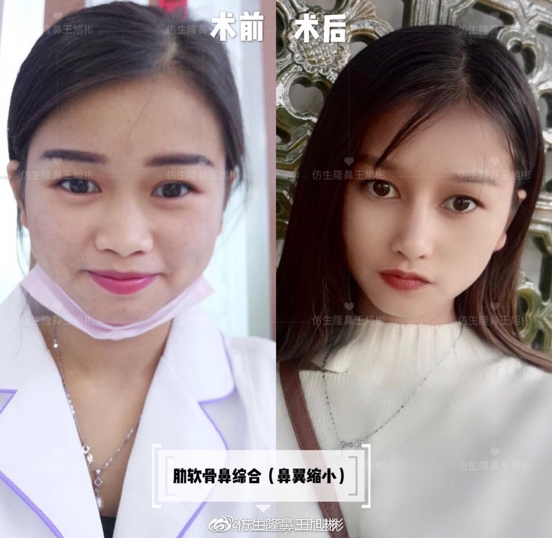 大宽朝天鼻整形过程,窄鼻子如何通过鼻整形来矫正