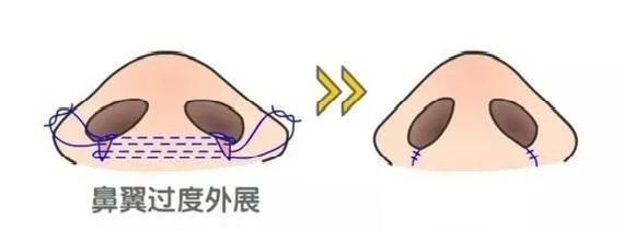鼻翼缩小和鼻头缩小需要全麻吗,鼻头缩小和鼻翼缩小有什么区别
