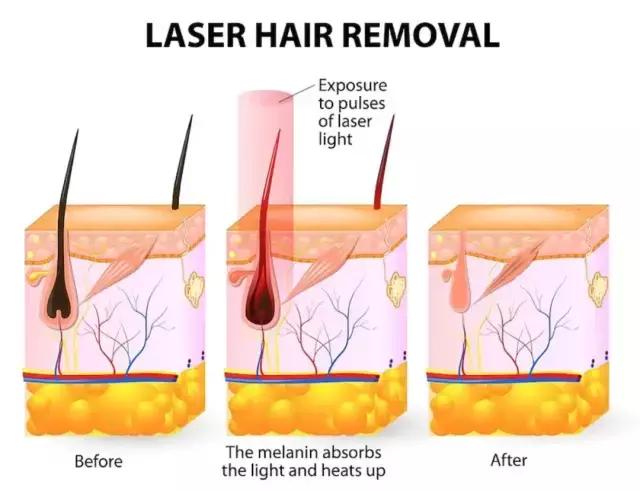 脱毛最好的方法目前最有效的,比较有效的脱毛方法