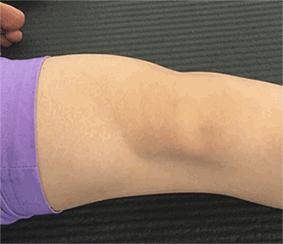 磁共振检查半月板损伤有误诊率吗,半月板磁共振会不会有误诊