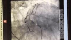 突发心脏骤停抢救措施总结会,心脏搭桥的血管闭塞怎么办