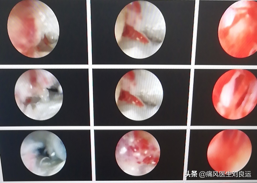 痛风能否真正根治,痛风病可以彻底治疗好吗