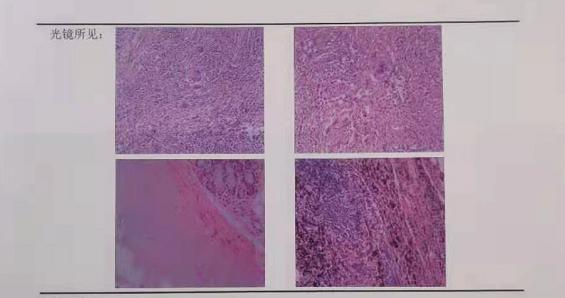 9mm肺结节实性结节良性几率多大,良性肺结节生长速度