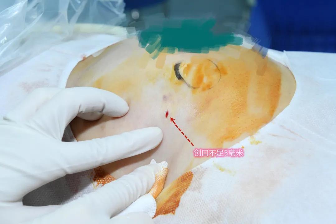 乳腺有毛刺形态不规则是恶性吗,乳腺肿块良恶性如何判断