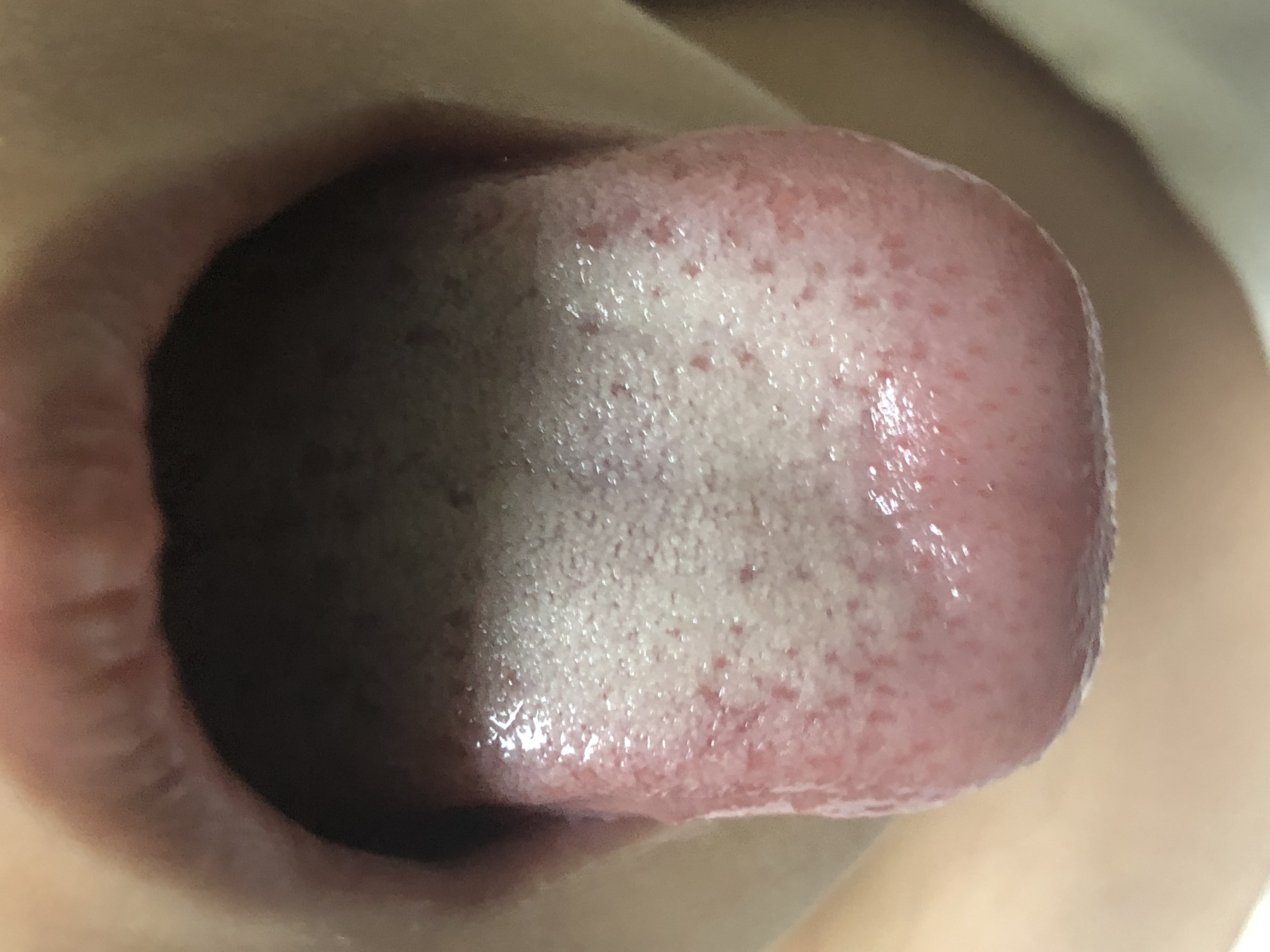 小孩如何通过舌象判断感冒,胃病反反复复看舌象