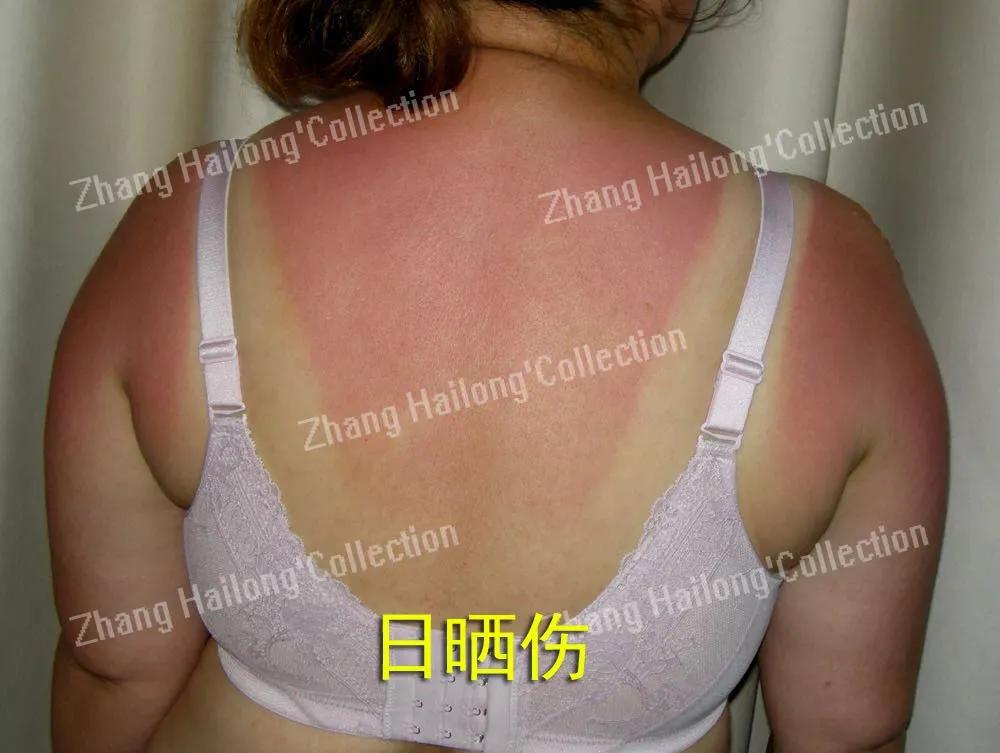 晒太阳两分钟会被紫外线伤到吗,太阳太晒如何防护