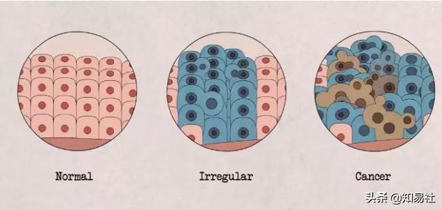 羞羞后警惕HPV感染，一不小心会得宫颈癌