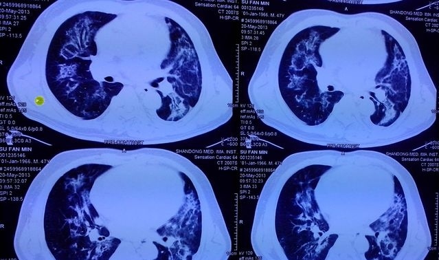 尿毒症并发症治疗,肾内科医生讲述的尿毒症患者