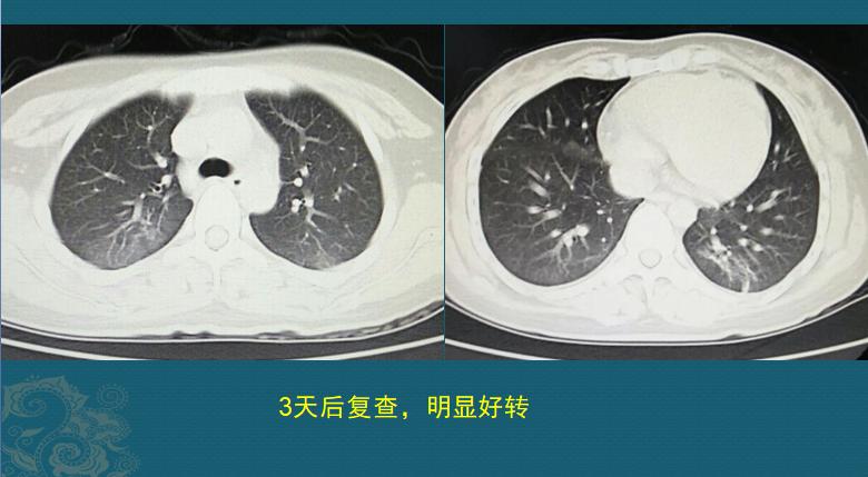 溺水后肺里有积水吗,溺水后肺里的水会出来吗