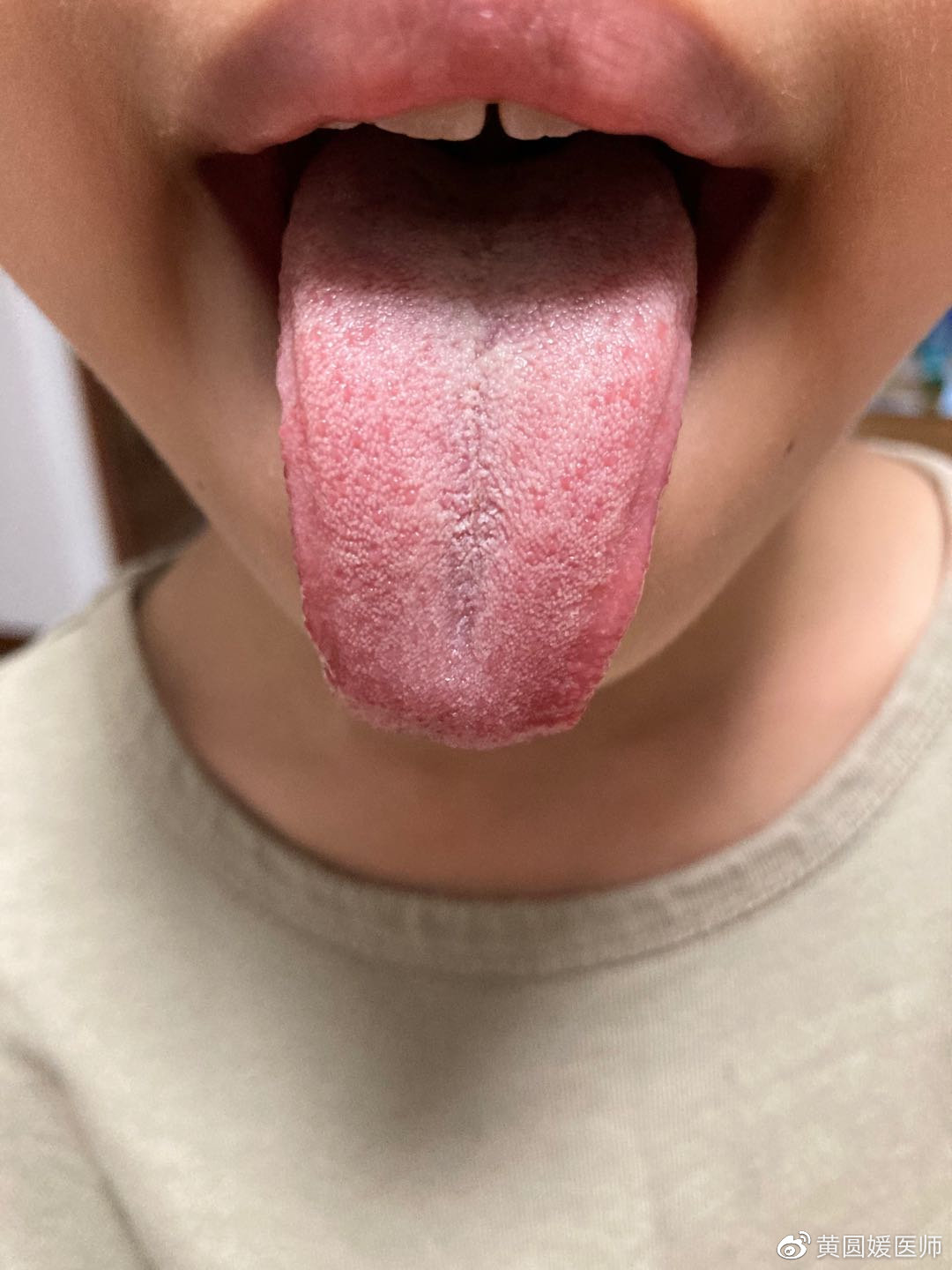 头痛喉咙发热老是想睡觉还咳嗽,孩子发热咳嗽头疼怎么办