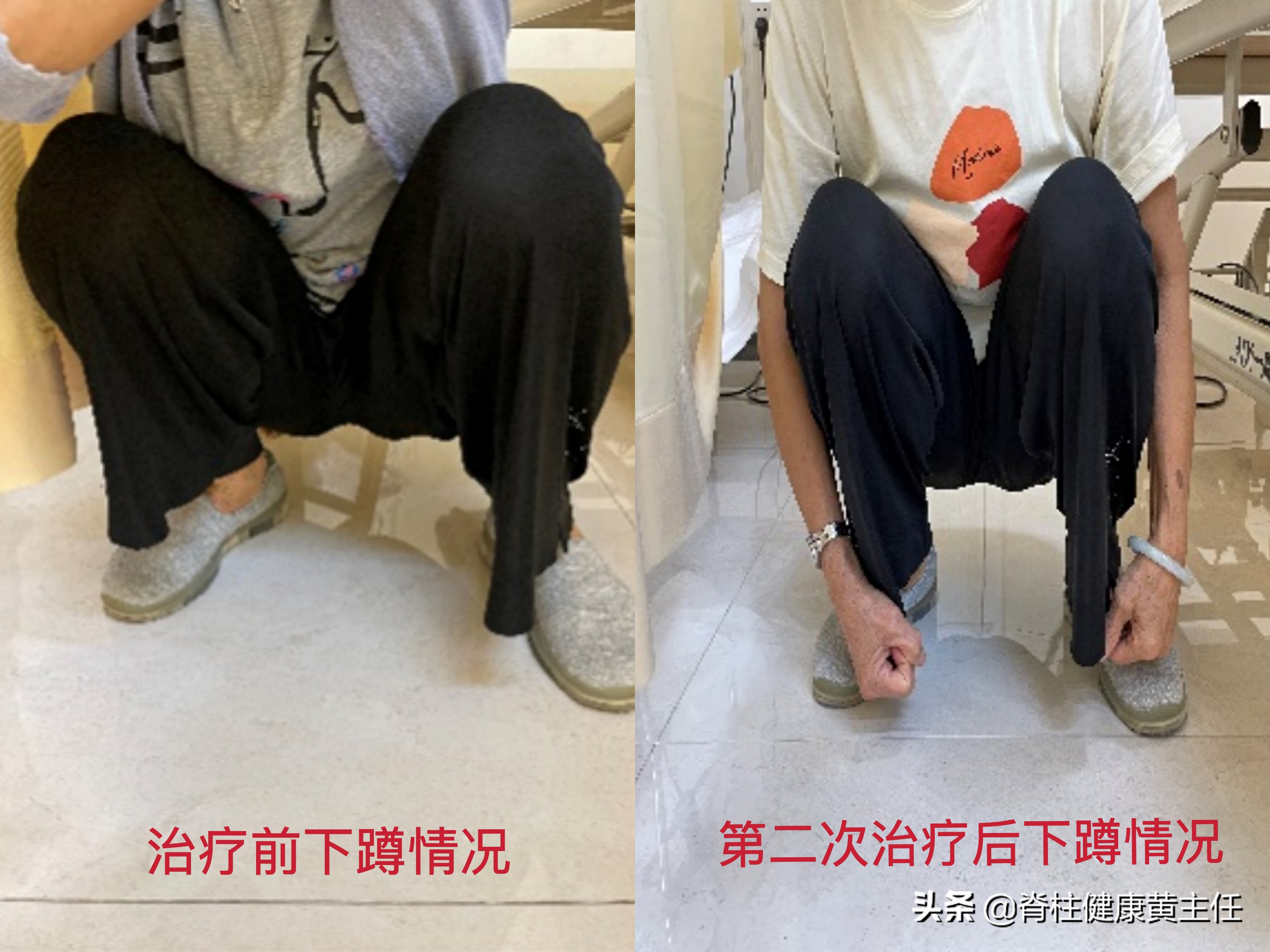 因摔倒致膝盖疼痛肿胀怎么治疗,摔倒后膝盖弯曲时疼痛且有肿胀感