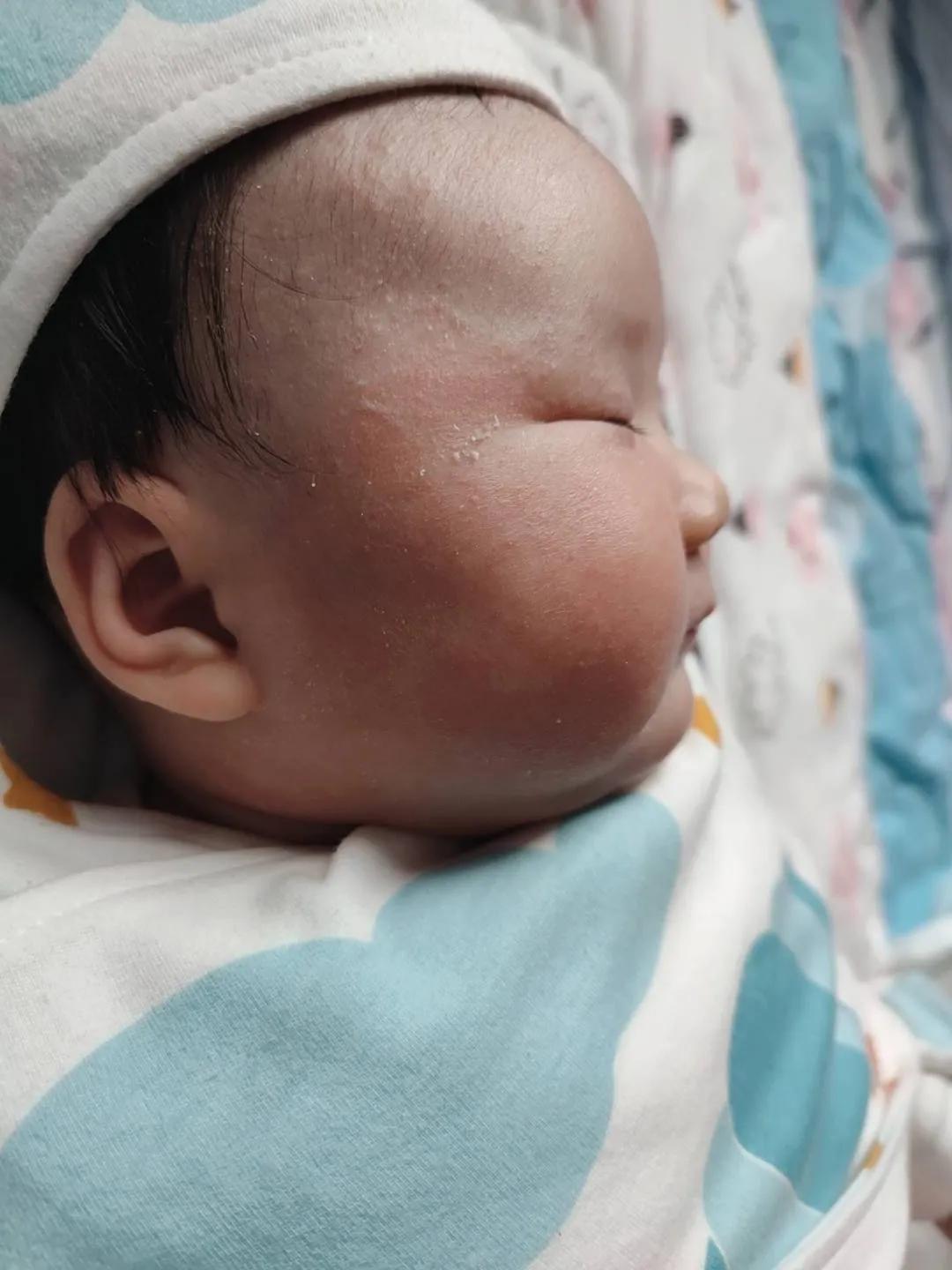 宝宝大作战8-9,宝宝湿疹大作战