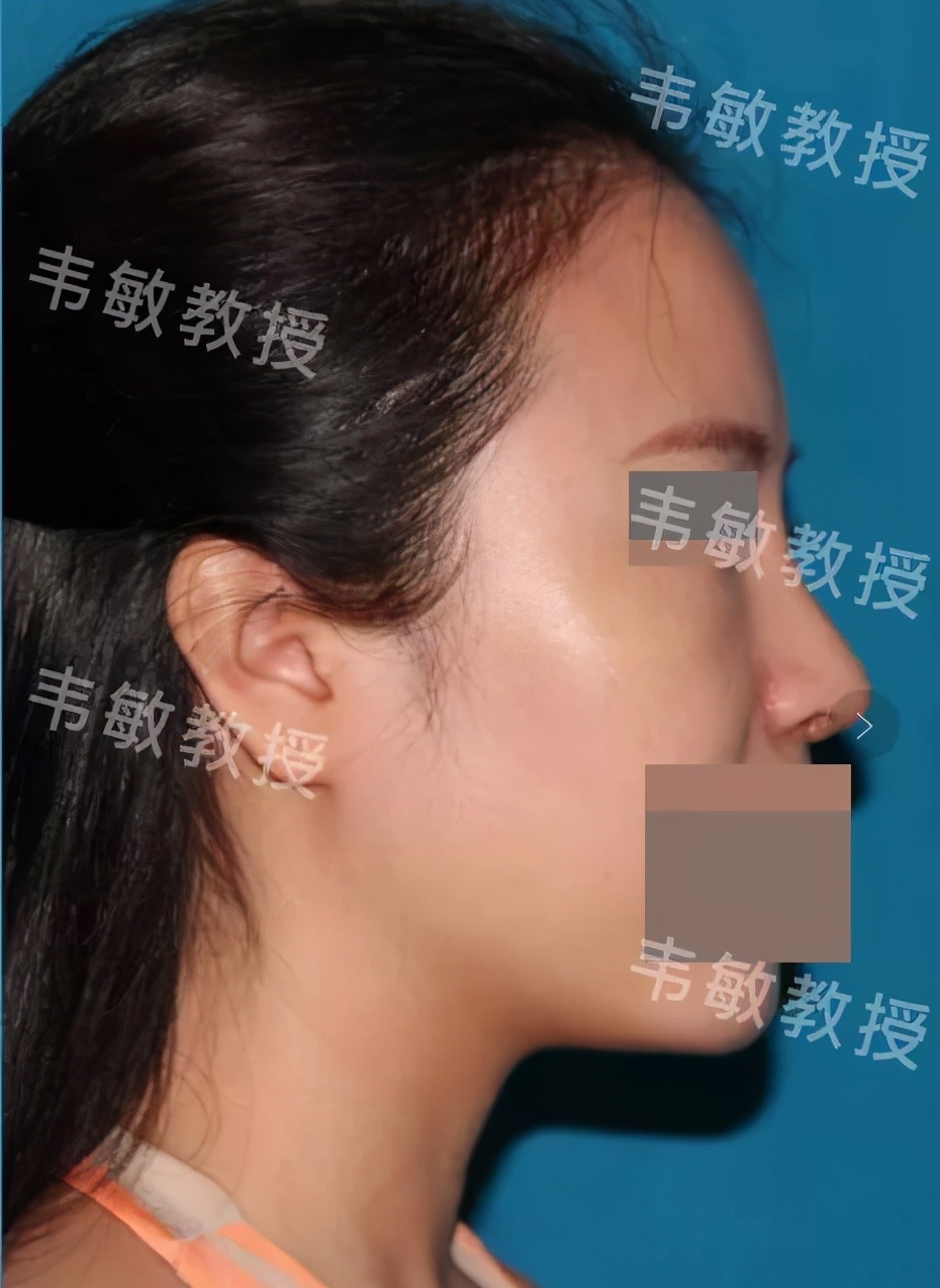 塌鼻子如何变成尖鼻子,形态欠佳怎么回事