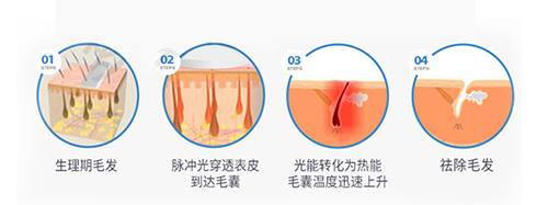 脉冲光脱毛有没有效果,脉冲脱毛嫩肤