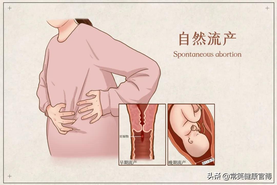 肚子里好好的孩子,怎么会不明原因流产?