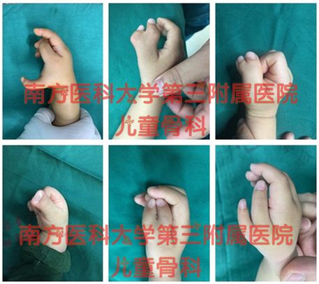 儿童多指畸形最佳治疗方法,宝宝多指畸形