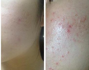 下巴长痘痘祛痘精华,下巴频繁长痘痘的正确消除方法