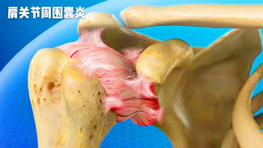 肩部痛找不到痛的地方,肩部痛的抬不起来