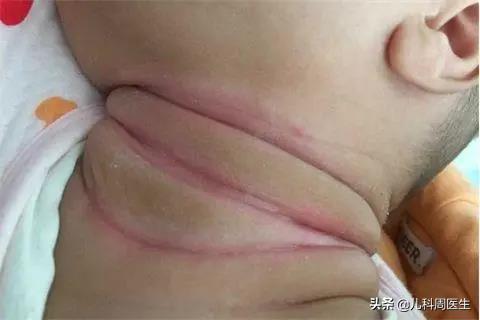 宝宝长痱子淹脖子怎么办,痱子和湿疹的预防和护理