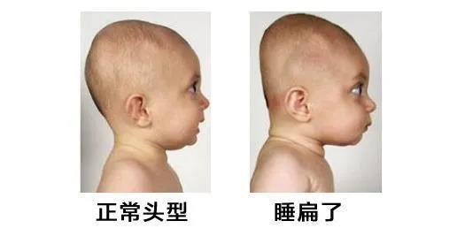 如何预防孩子扁头,怎么预防婴儿睡扁头